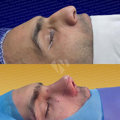 نمونه عمل بینی استخوانی