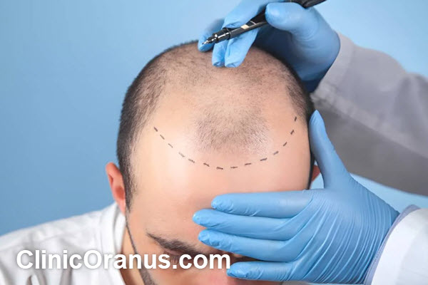 بررسی روش های کاشت مو در مراکز تخصصی | کلینیک اورانوس
