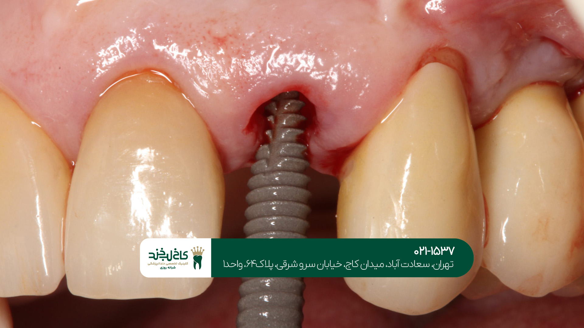 کلینیک دندانپزشکی ایمپلنت