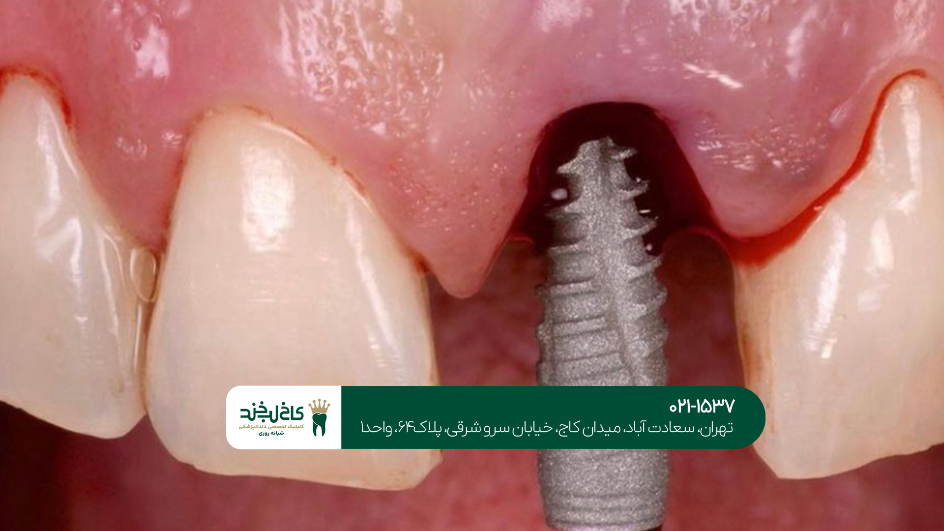 مرکز ایمپلنت دندان
