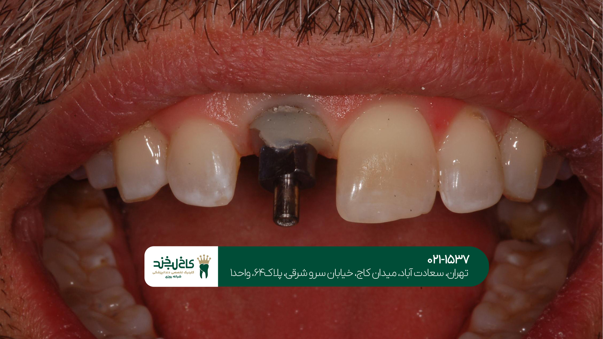 ایمپلنت دندان