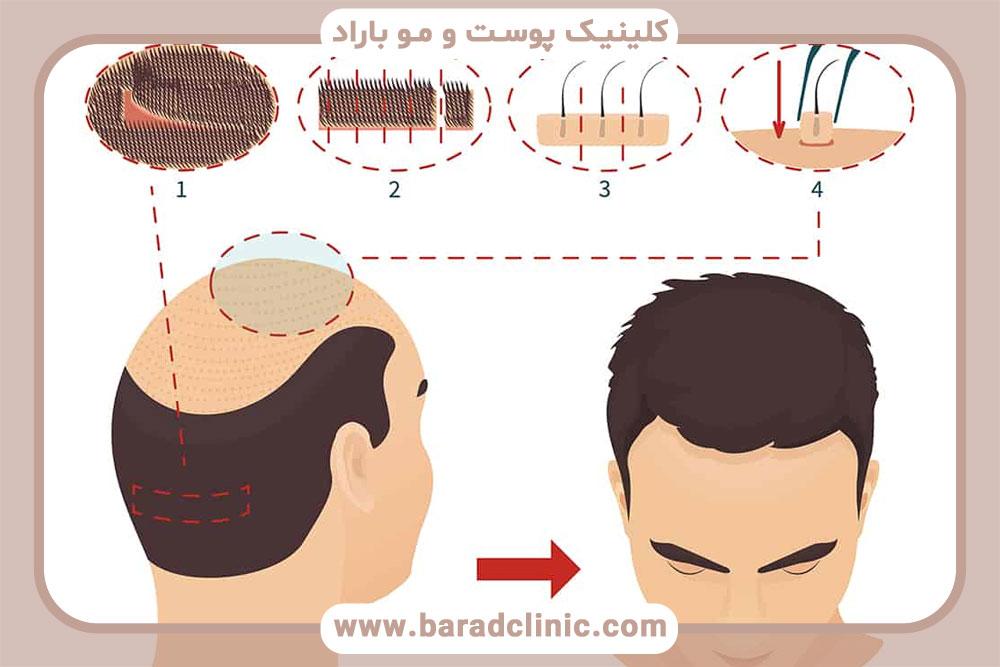 چگونه کاشت مو می‌تواند چهره را جوان کند؟