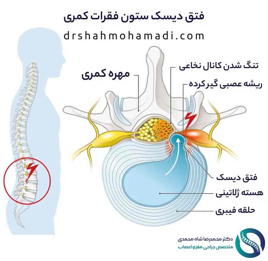 دیسک کمر چیست؟ - دکتر شاه محمدی جراح دیسک کمر در تهران