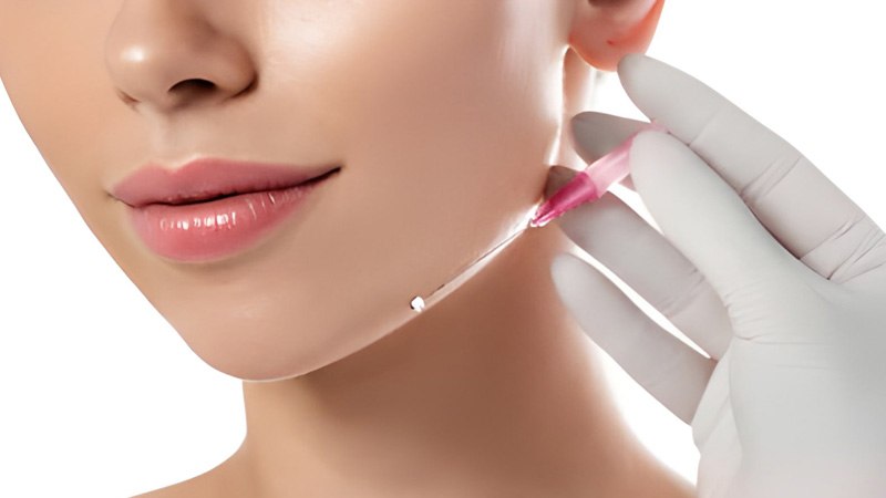 لیفت صورت با نخ در شیراز