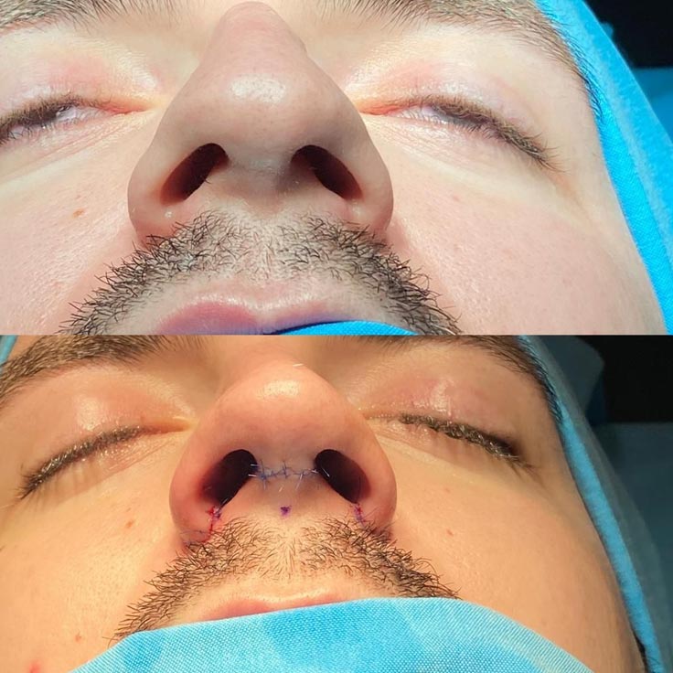 آلارپلاستی