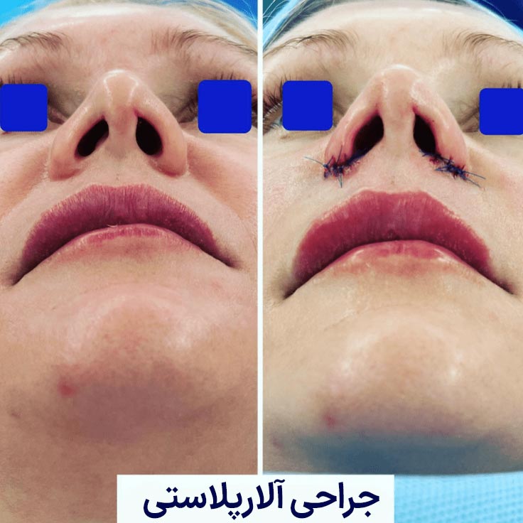 قبل و بعد از جراحی آلارپلاستی