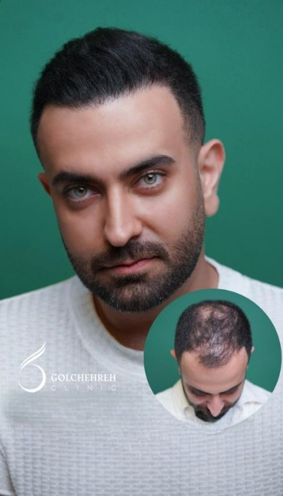- کاشت مو در کلینیک تخصصی؛ از مشاوره تا نتیجه نهایی - بهترین کلینیک کاشت مو