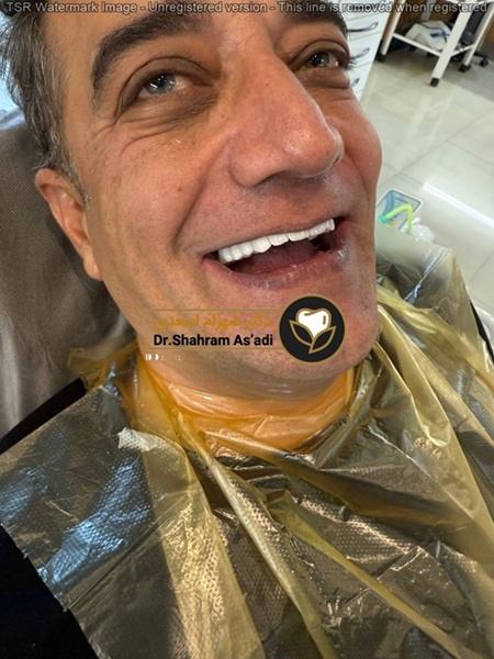 طراحی و کاشت ایمپلنت دیجیتال با استفاده از فناوری تصویربرداری سه‌بعدی