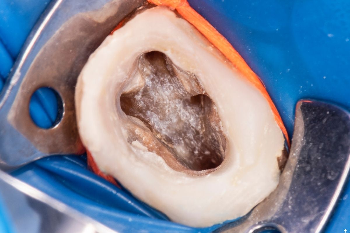 یک جلسه عصب‌کشی