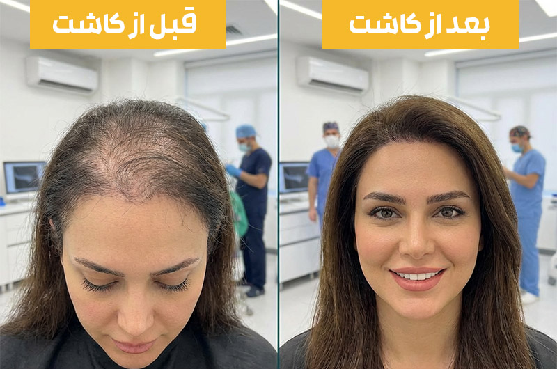 قبل و بعد کاشت مو زنان