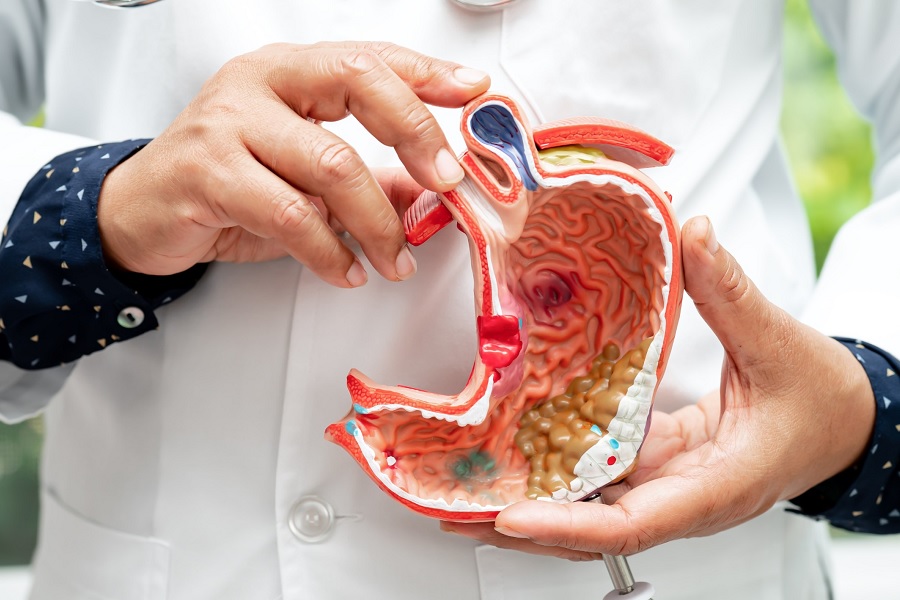 آیا اسلیو معده خطرناک است؟