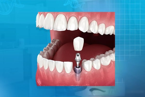 ایمپلنت دیجیتال در تهران