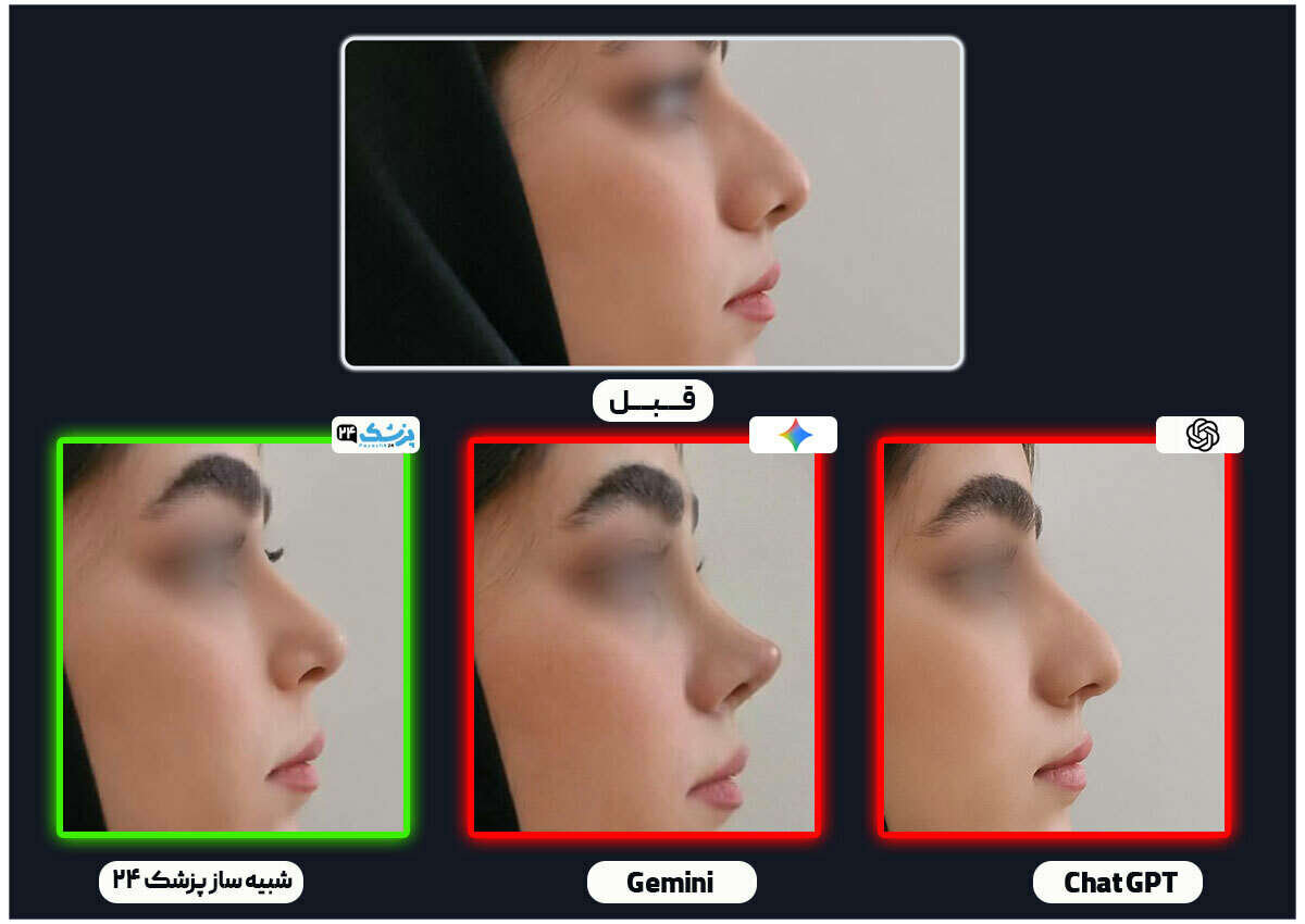 جراحی بینی در تهران با رینوبات