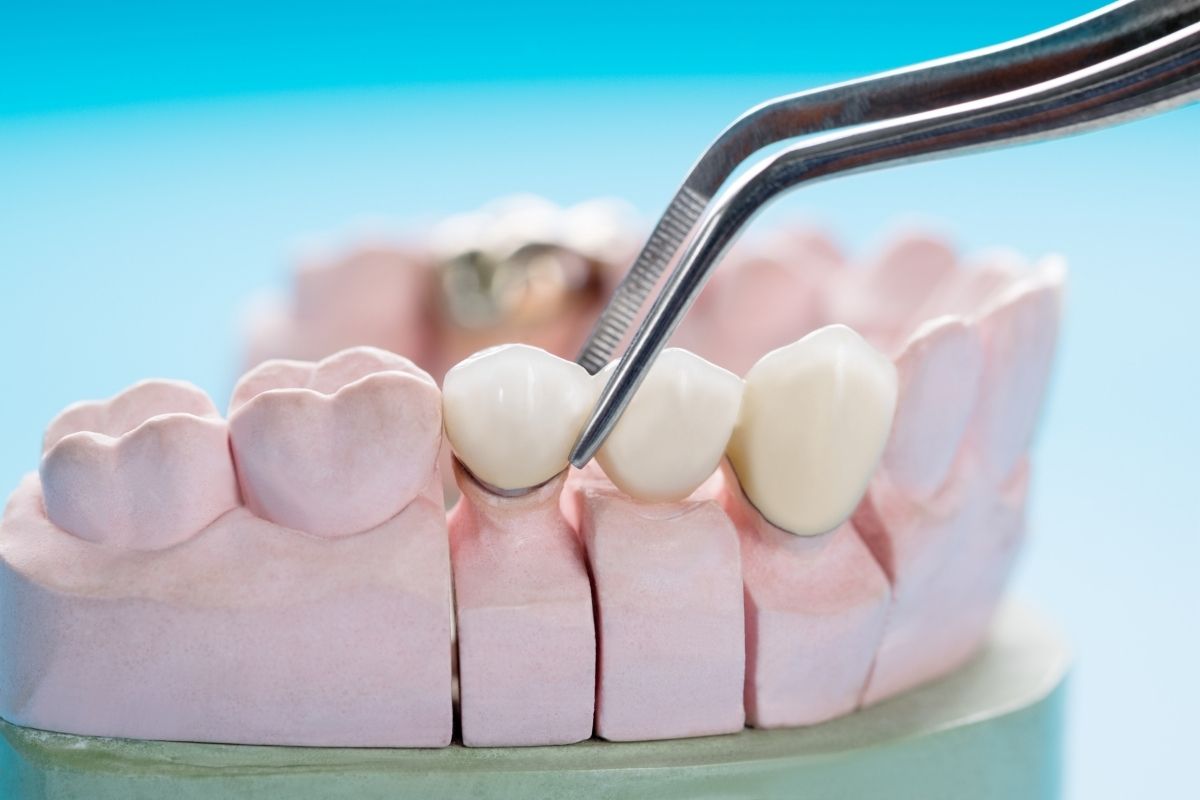 چرا ایمپلنت دیجیتال در تبریز انتخاب مطمئن‌تری است؟