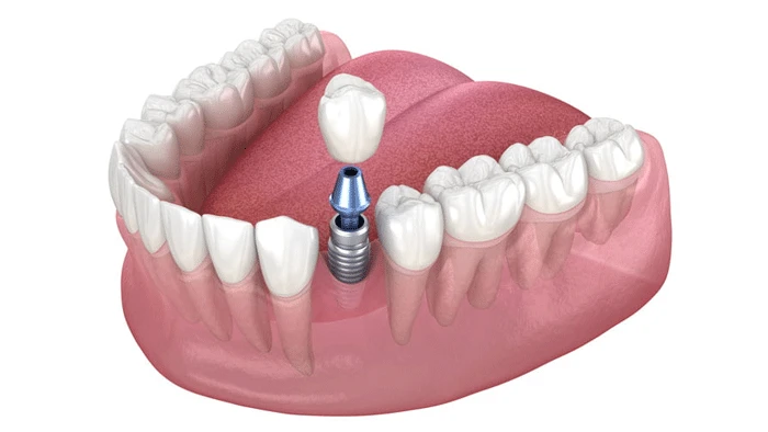 نکاتی که قبل از کاشت ایمپلنت باید بدانید