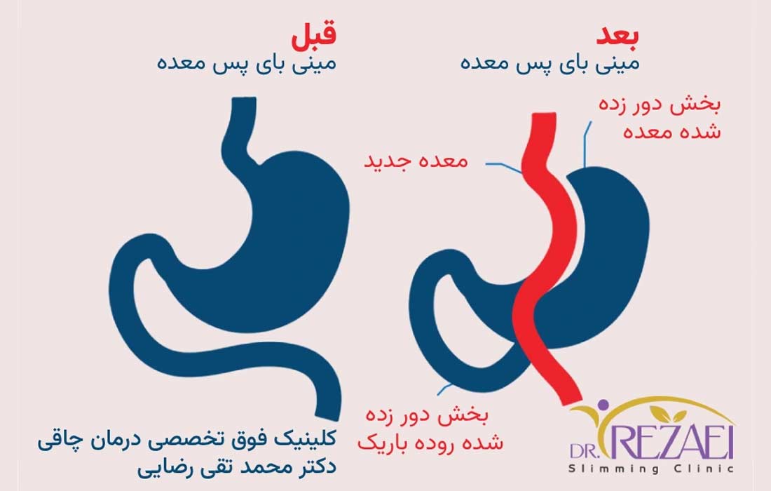 عمل مینی بای پس - دکتر محمدتقی رضایی جراح مینی بای پس معده