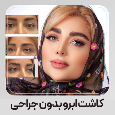 نمونه کاشت ابروی بدون جراحی