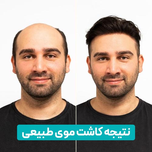 نتیجه کاشت موی طبیعی