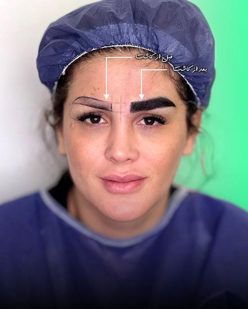 نتیجه کاشت ابرو