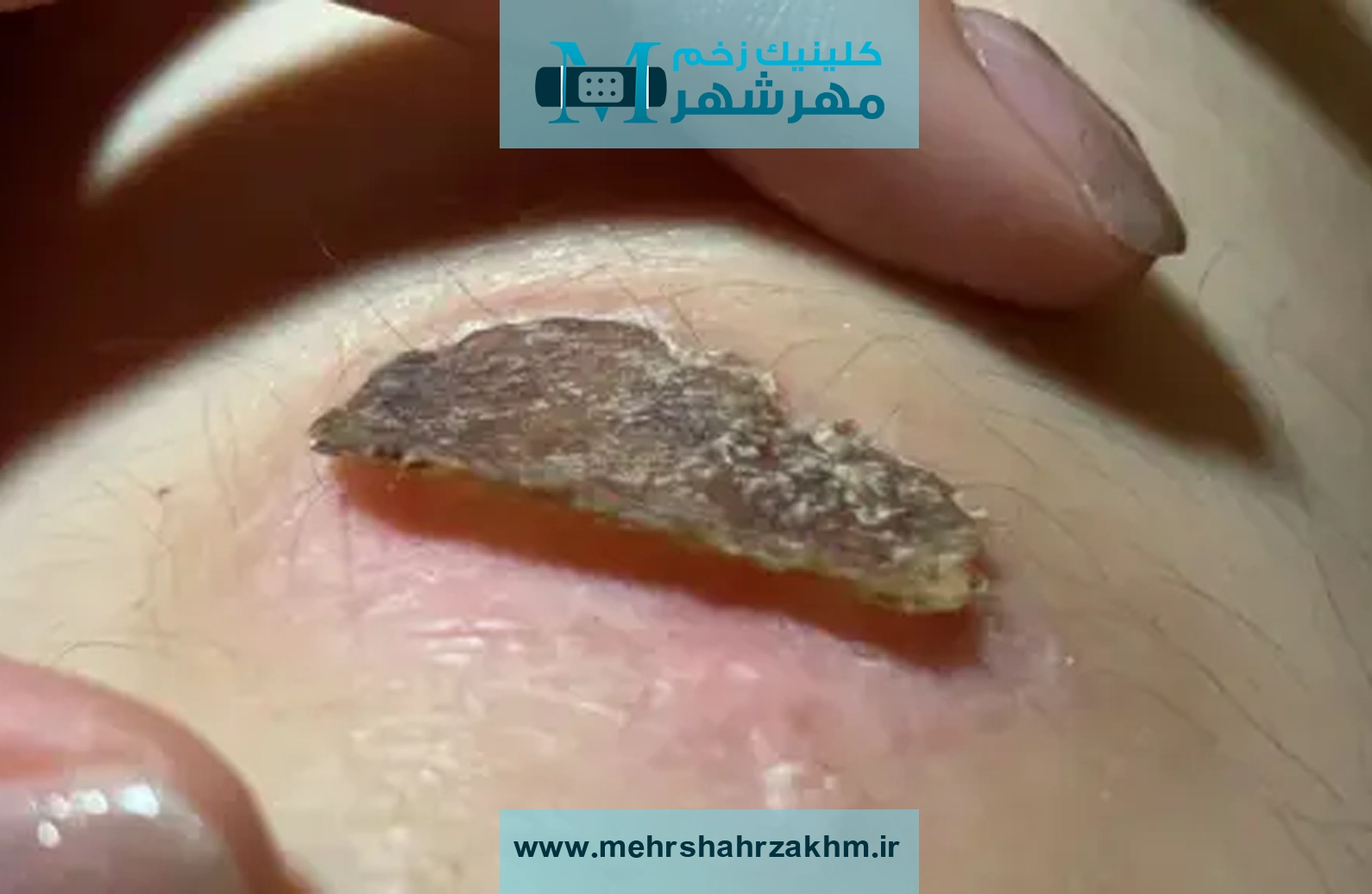 اگر این تغییر رنگ را در زخم دیدید، خطر نزدیک است!❗🛑 3