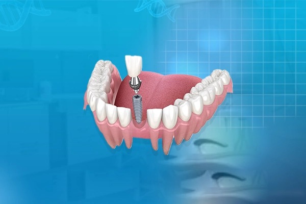 ایمپلنت دیجیتال