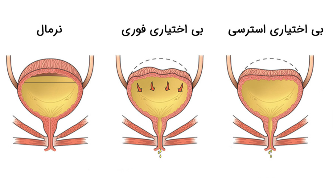 انواع بی اختیاری ادرار