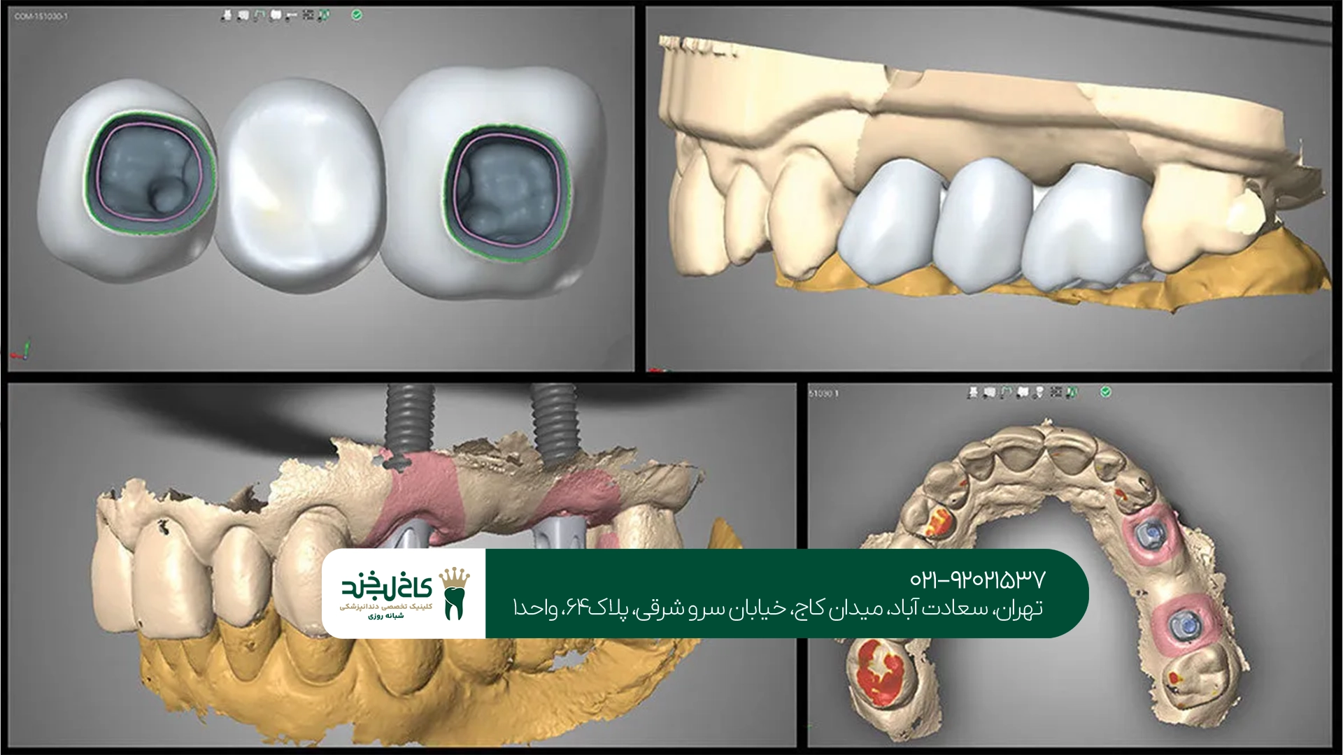 ایمپلنت دیجیتال