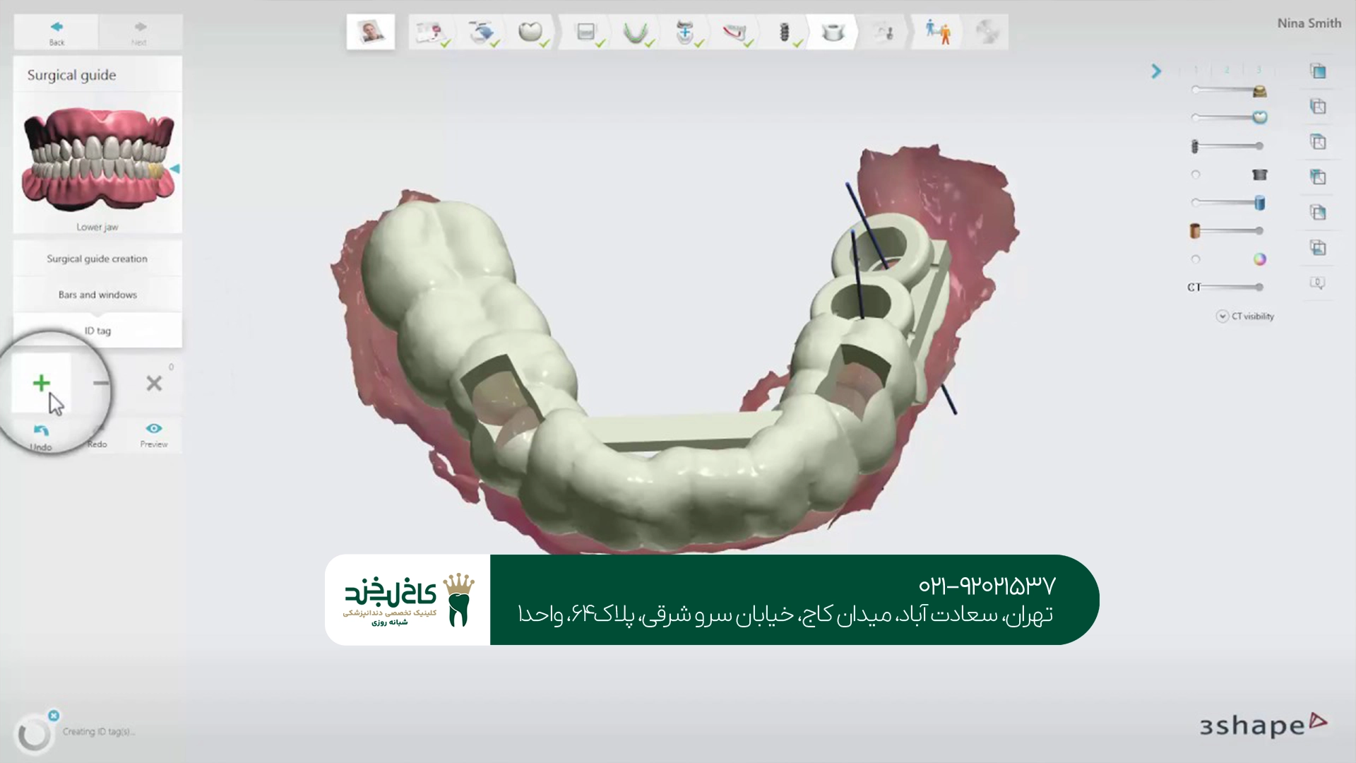 ایمپلنت دندان
