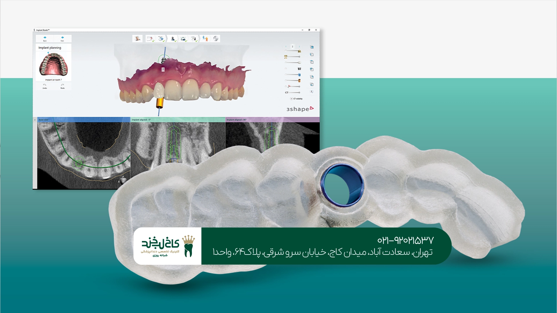 ایمپلنت فوری تهران