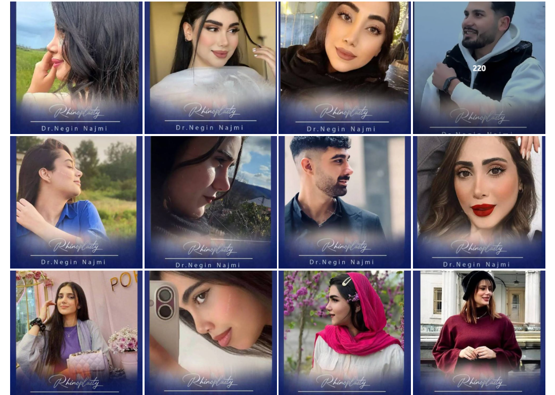 عکس نمونه کار |بهترین جراح بینی در رشت دکتی نگین نجمی