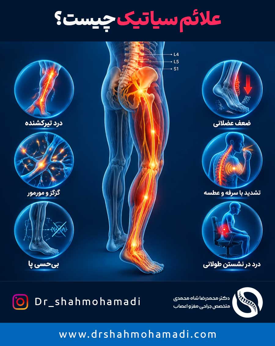 علائم سیاتیک چیست؟ 6 علامت اصلی سیاتیک - دکتر محمدرضا شاه محمدی