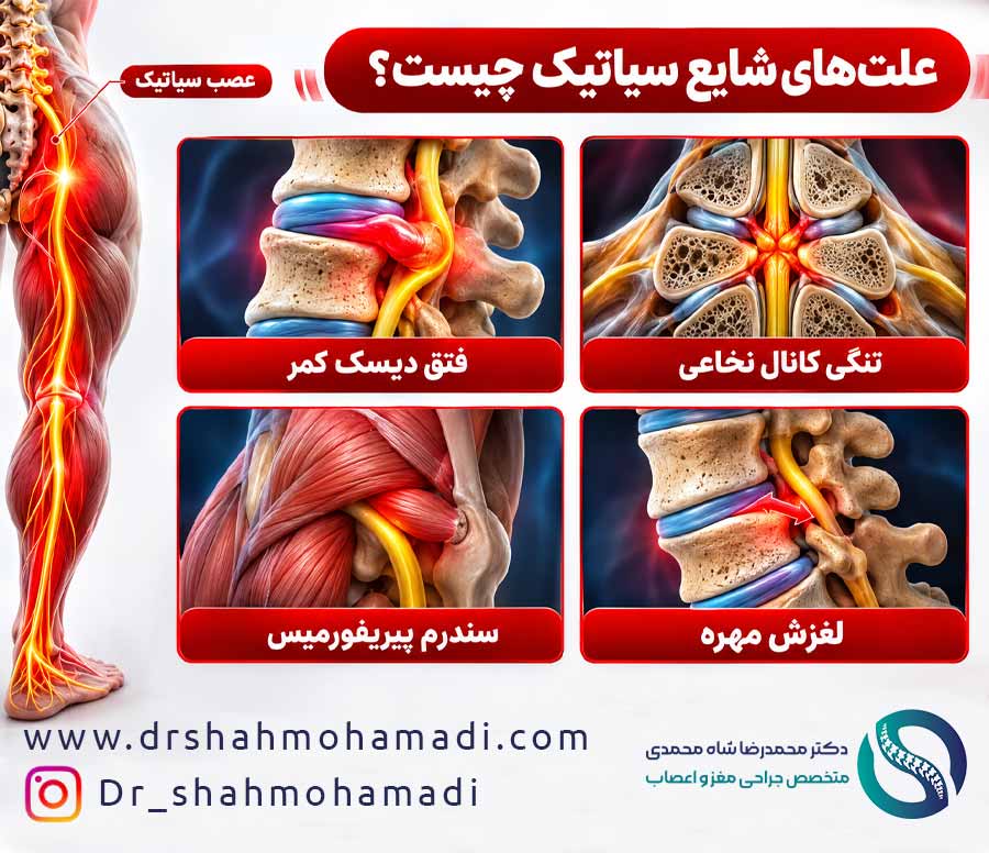 4 علت اصلی سیاتیک - دکتر محمدرضا شاه محمدی