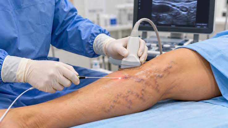 Laser variceal therapy